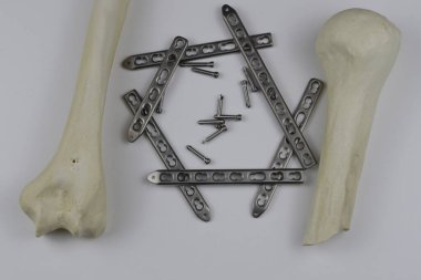 Kemik kırıklarına karşı osteosentez için cerrahi plakalar