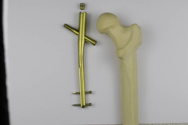 Kemik kırıklarına karşı osteosentez için cerrahi plakalar