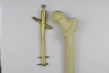 Kemik kırıklarına karşı osteosentez için cerrahi plakalar