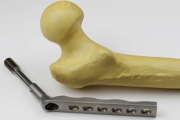 Csonttörések Esetén Oszteoszintézis Műtéti Lemezei — Stock Fotó
