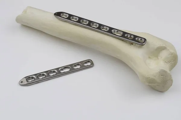 Csonttörések Kezelésére Szolgáló Sebészeti Eszközök — Stock Fotó