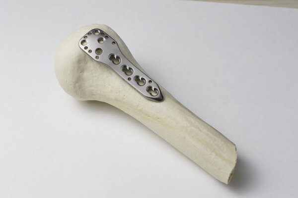 Хирургические пластины для остеосинтеза в случае переломов костей