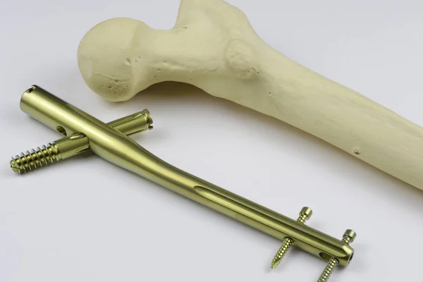 Csonttörések Esetén Oszteoszintézis Műtéti Lemezei — Stock Fotó