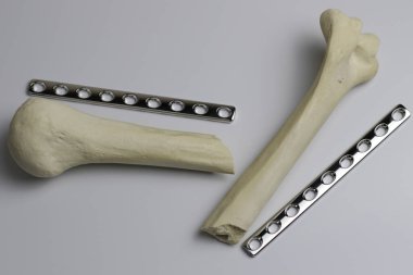 Ameliyat odasındaki kemik kırıklarına karşı osteosentez için cerrahi aletler.