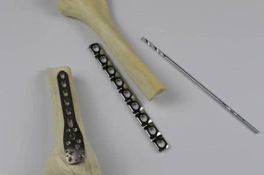 Cerrahi plaka LCP ve travmatolojide kemik kırıkları için vidalar.