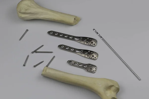 Хірургічна Пластинка Остеосинтезу Переломах Кісток — стокове фото