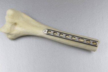 Kemik kırıkları için cerrahi aletler