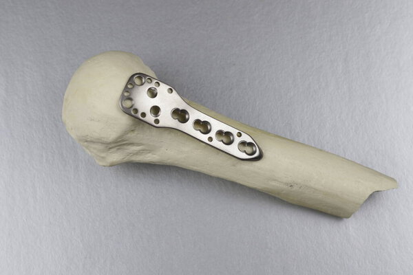 Хирургические инструменты для операционных переломов костей