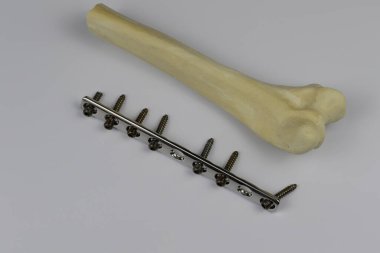 Kemik kırıkları için cerrahi aletler