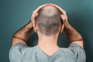 Görünüşü yüzünden acı çeken bir insan. Keltoş esmer adam elleriyle kafasını tutuyor. Arkadan bak. Turkuaz arka plan. Kellik ve kellik kavramı.