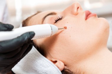 Profesyonel salon prosedürleri. Cerrah, beni çıkarmak için lazer cihazı kullanıyor. Kadın yüzünden doğum lekesinin çıkarılması. Kapatın. Lazer kozmetik ve elektropıhtılaşma kavramı.
