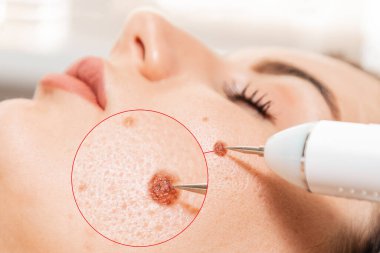 Elektropıhtılaşma ve lazer kozmetik. Dermatolog, beni çıkarmak için profesyonel bir elektrokoterapi kullanıyor. Melanomun yakınlaştırılmış alanı.