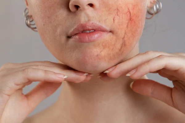 Cosmetología Rosácea Retrato Cara Media Mujer Manos Barbilla Una Mejilla — Foto de Stock