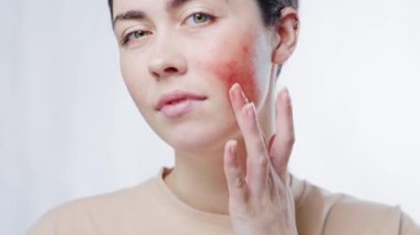 Genç ve güzel bir kadının yakın plan portresi parmaklarıyla yanağındaki kızarıklığa dokunuyor. Beyaz arka plan. Rosacea ve couperose konsepti.