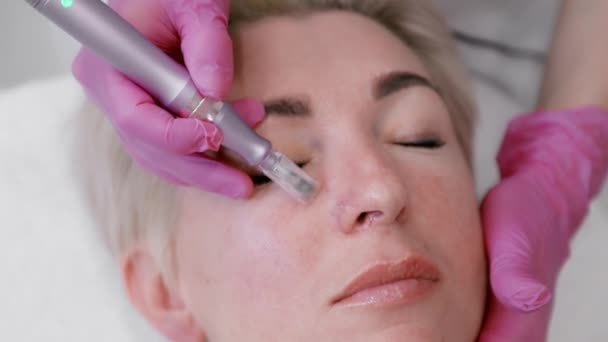 Adult Woman Receives Gas Liquid Peeling Procedure Professional Cosmetologist Services — Stock Video