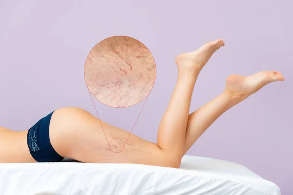 Young woman is lying on her stomach, lifting her legs up. Zoomed area of vascular asterisks on the leg. Pale lilac background. The concept of varicose veins.