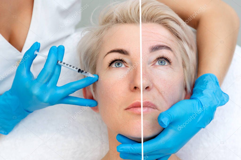 Beautician doctor in medical gloves holding filler syringe making injection to cheek. Anti-aging treatment and face lift in cosmetology clinic. Results before and after.