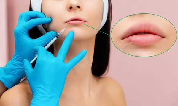 Uma Jovem Procedimento Aumento Labial Esteticista Luvas Borracha Azul Uma — Fotografia de Stock