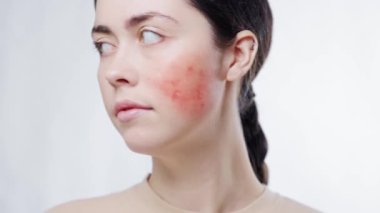 Dönüp yanağında rosacea gösteren güzel bir kadının yakın plan portresi. Beyaz arka plan. Estetik deri sorunu kavramı