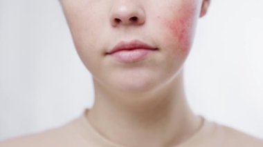 Dönüp yanağında rosacea gösteren genç ve güzel bir kadının yakın plan yüzü. Beyaz arka plan. Estetik deri sorunu kavramı