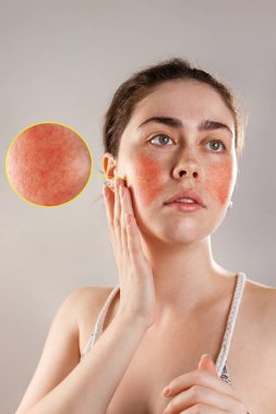 Cosmetology and rosacea. The young woman runs her hands over her reddened, inflamed cheeks and rosy forehead. The enlarged image of blood vessels.