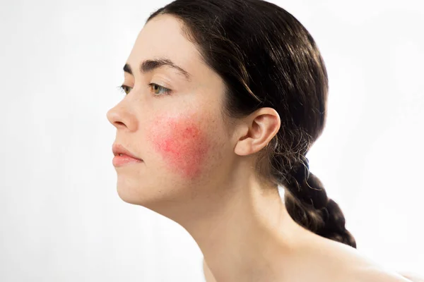 Couperose Portrait Young Beautiful Caucasian Woman Rosacea Her Cheek Isolated — Stock Photo, Image