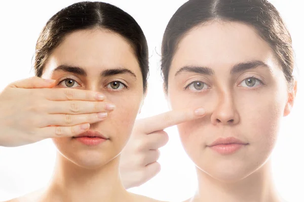 若い白人女性の2つの顔は彼女の鼻を手で覆い 鼻の曲がった橋を指しています 白い背景に隔離されている 鼻形成術と審美的な美容の概念 — ストック写真