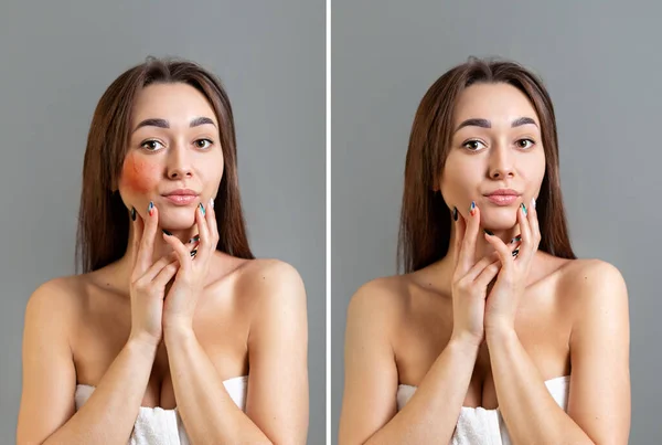 Concept Rosacea Young Caucasian Woman Touches Her Cheeks Rosacea Copy — Stock Photo, Image