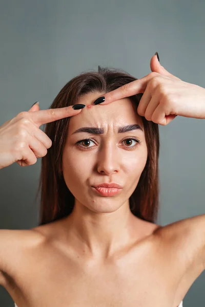 Cosmetologia Dermatologia Acne Una Giovane Bruna Caucasica Spreme Brufolo Sulla — Foto Stock