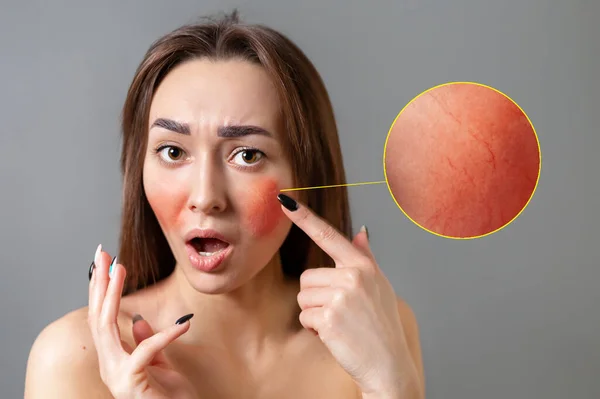 Concept Rosacea Young Caucasian Woman Points Her Finger Surprise Red — Stock Photo, Image