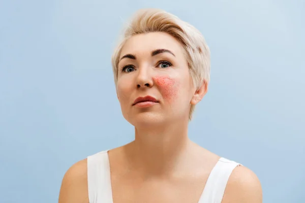 Retrato Mulher Loira Adulta Com Rosácea Bochecha Conceito Couperose Tratamento — Fotografia de Stock