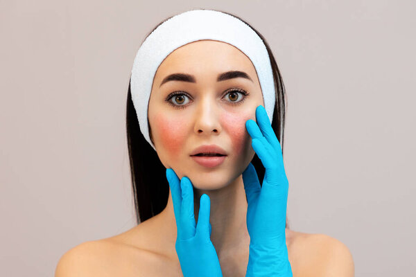 Portrait of a young beautiful woman in protective gloves, touches face with couperose on cheeks. Rosacea and skin irritation concept.