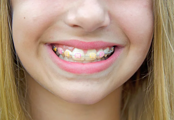 Caucasian girl with orthodontic braces — Stock Photo, Image