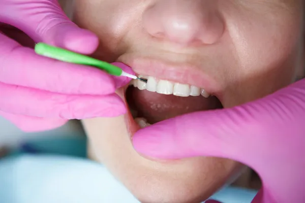 Zbliżenie Stomatologa Przy Użyciu Szczoteczki Zębów Między Zębami Pacjenta — Zdjęcie stockowe
