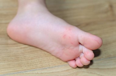 Bir çocuğun vücudunda Enterovirüs Ayakları Kızarıklığı. Sırt çantası virüs isiliği. İlk aşama başlıyor. Ayakta benekler var..