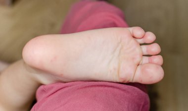 Bir çocuğun vücudunda Enterovirüs Ayakları Kızarıklığı. Sırt çantası virüs isiliği. İlk aşama başlıyor. Ayakta benekler var..