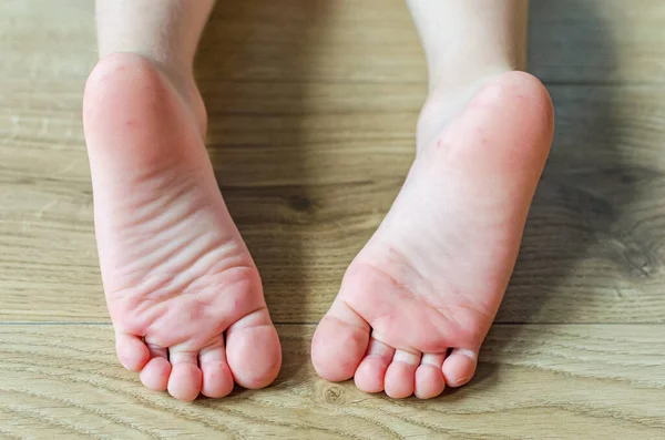 Bir çocuğun vücudunda Enterovirüs Ayakları Kızarıklığı. Sırt çantası virüs isiliği. İlk aşama başlıyor. Ayakta benekler var..