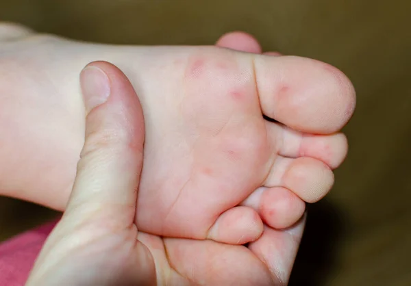 Enterovirus Feet Erupção Cutânea Corpo Uma Criança Erupção Cutânea Vírus — Fotografia de Stock