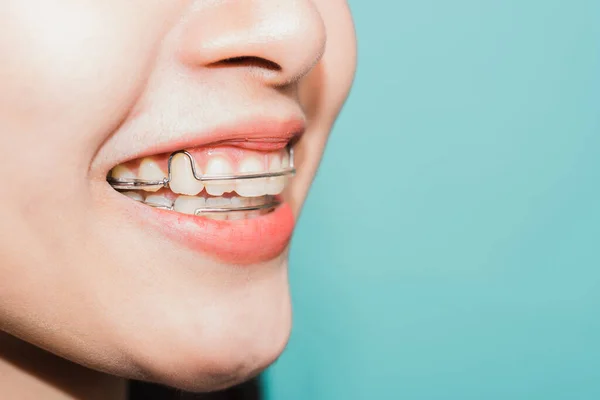Zblízka Bílé Zuby Mladé Asijské Krásné Ženy Usmívající Nosit Silikonové — Stock fotografie