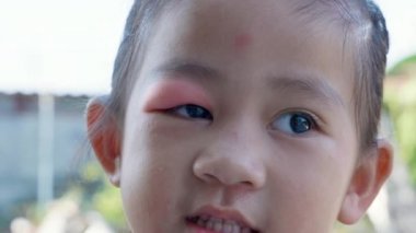 Stye Eye diseases. Closed Asian kid little girl eye with sty, eyelid abscess ophthalmic hordeolum