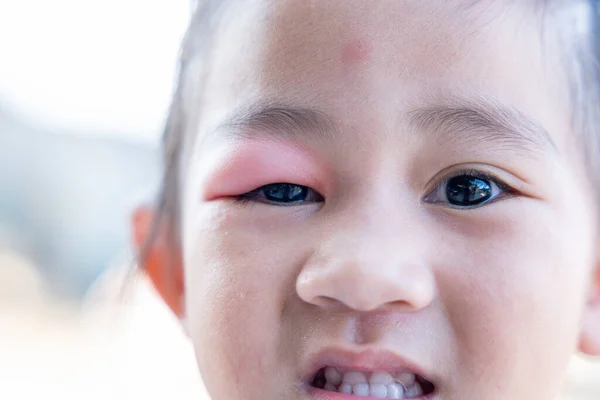 Stye Eye Diseases Closed Asian Kid Little Girl Eye Sty — Stock Photo, Image