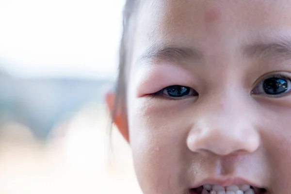 Захворювання Очей Замкнута Азіатська Маленька Дівчинка Каштановим Оком Абсцес Офтальмічний — стокове фото