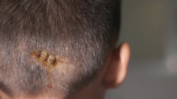 Herida Suturada Lacerada Cabeza Del Niño Que Sutura Con Sutura — Vídeo de stock