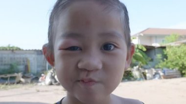 Stye Eye diseases. Closed Asian kid little girl eye with sty, eyelid abscess ophthalmic hordeolum