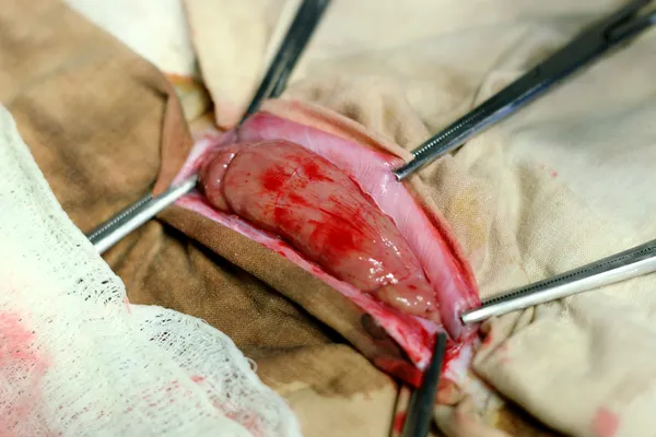 Ferida cirúrgica — Fotografia de Stock