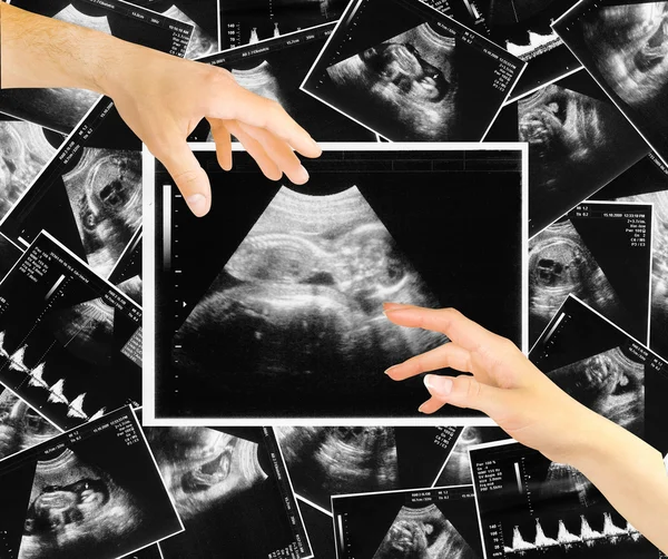 Dois braços de amantes e a criança no ultrassom de imagem — Fotografia de Stock