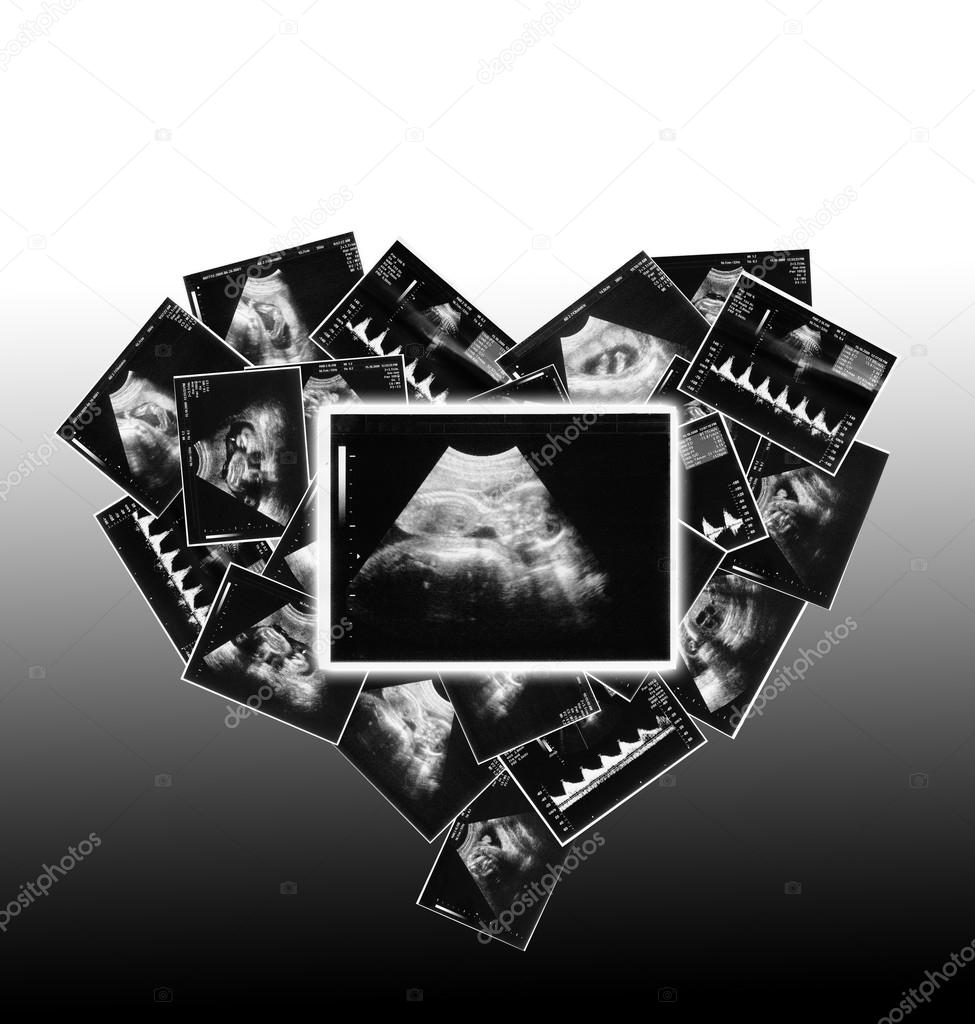 Child in the picture ultrasound