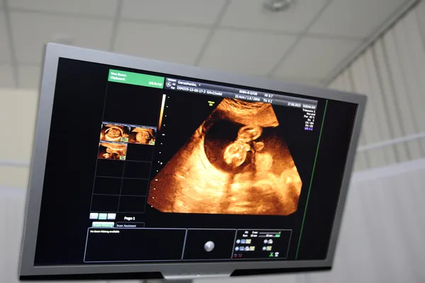 Un niño en la pantalla de ultrasonido en el abdomen de un embarazo — Foto de Stock