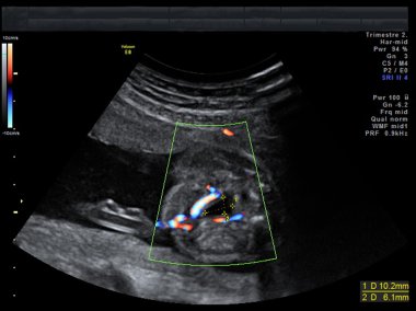 Bebeğin ultrason görüntüsü