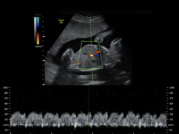 Baby op de echografie afbeelding — Stockfoto